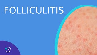 Folliculitis  Daily Dos of Dermatology [upl. by Bubb]