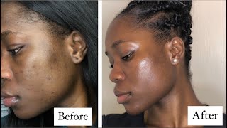 Clear Skin In 3 Months On Low Dose Accutane  What You Should Know  Helen Suah  acne [upl. by Hjerpe909]