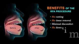 Treating Sleep Apnea with the RFA Procedure [upl. by Schlessel]