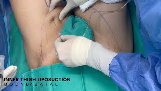 Inner Thigh Liposuction  Awake Liposuction [upl. by Dallman]