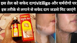 बाकूची तेल  सफेद दाग एवं चर्मरोगो का रामबाण इलाज।।Vyas Bakuchi Oil BenifitsUses and Side effects [upl. by Jumbala263]