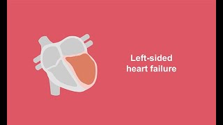 Classifying leftsided heart failure [upl. by Airdnal]