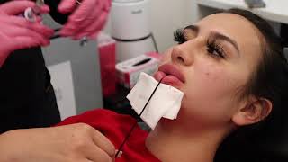 GETTING LIP INJECTION FILLER Keyhole Pout Technique with Juvederm Ultra XC at California Cosmetics [upl. by Yekim]