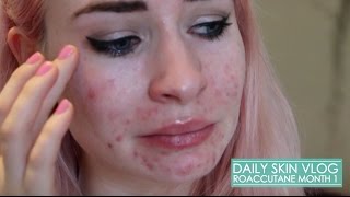 Roaccutane Daily Skin Vlog  Month 1 [upl. by Gorski]