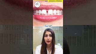 Do you have Teeth Gaps Watch this Dr Srishti Bhatia gaps smilemakeover teethgapmakeover [upl. by Alex]