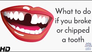 What To Do If You Broke Or Chipped A Tooth [upl. by Alded411]