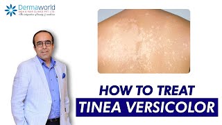 Tinea versicolor  Dr Rohit Batra  Tinea Versicolor Treatment  How to treat Tinea Versicolor [upl. by Bocock]