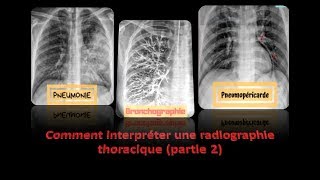 clichés thoraciques interprétés  partie 2  pneumologie radiologie [upl. by Bobbi527]