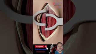 3D animation intubation procedure shorts youtubeshorts hospital viralvideo [upl. by Leelahk751]