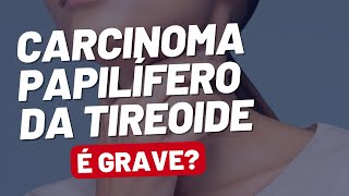 Carcinoma Papilífero de Tireoide o Câncer Mais Comum da Tireoide [upl. by Alih]