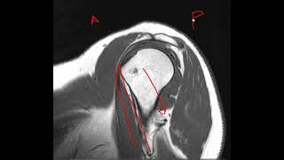 Anatomía RM hombro [upl. by Pages]