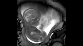 MRI scan at 21 weeks [upl. by Ylram]