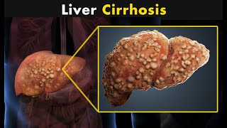 What Happens In Liver Cirrhosis  Symptoms Causes And Treatment [upl. by Aniale936]