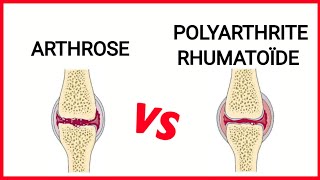 La différence entre l’arthrose et la polyarthrite rhumatoïde [upl. by Joanna]