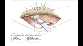 Medial Approach to the Elbow [upl. by Howell]