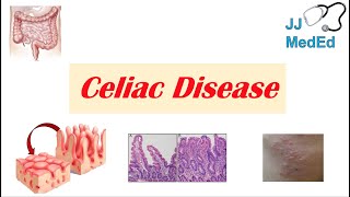 Celiac Disease amp Gluten Sensitivity Risk Factors Pathogenesis Symptoms Diagnosis Treatment [upl. by Iolande950]