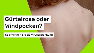 Gürtelrose oder Windpocken So erkennen Sie die Viruserkrankung [upl. by Erodasi519]