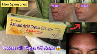 Aziderm 10 Cream Review  Azelaic Acid Cream Review [upl. by Stone761]