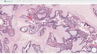 Complete Hydatidiform Mole  Histopathology [upl. by Egiarc522]