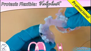 Prótesis Removible Flexible Valplast [upl. by Ettesel439]