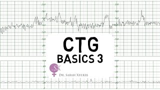 CTG Basics Part 3  Overall Assessment amp Examples [upl. by Horgan]