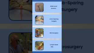 Liposarcoma Screening amp Treatment Options [upl. by Eimarej]