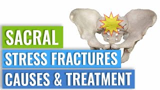 Sacral Stress Fractures  Causes amp Treatment [upl. by Sethi408]