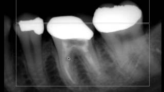 Endodontic Radiographs  Is there a minimum number [upl. by Prissie]