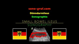 Sonographie  Dünndarmileus [upl. by Wojcik]