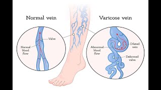 Varicose veins test’s [upl. by Orten]