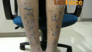 Severe Hypertrophic Lichen Planus with Severe Lichenification on Legs Treated at Life Force [upl. by Johnath]