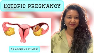 Ectopic pregnancy and its management ectopicpregnancy ectopic [upl. by Markos888]