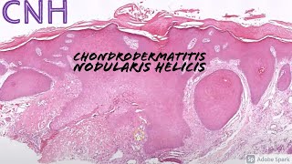 Chondrodermatitis Nodularis Helicis CNH 5Minute Pathology Pearls [upl. by Nosrak]