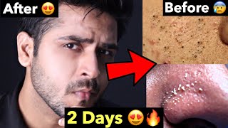 How to Remove Blackheads Whiteheads Naturally  Tips To Remove Whiteheads Blackheads From FACE [upl. by Remot]