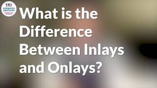 What is the Difference Between Inlays and Onlays [upl. by Robin]