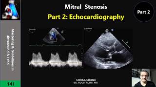 Mitral Stenosis Part 2 Echocardiography [upl. by Denie]