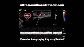 Tardus Parvus Spectral Doppler [upl. by Ruth]