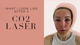 My CO2 Laser Experience PostTreatment Transformation and Recovery Tips by an Expert Dermatologist [upl. by Kathye]