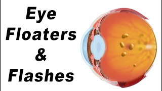 Eye Floaters What Are They amp What Causes Them [upl. by Itida]