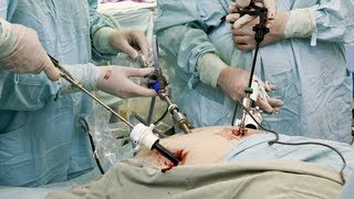 Laparoscopic Cholecystectomy [upl. by Vijar]