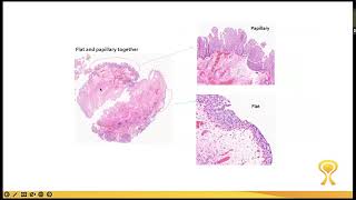 Understanding Carcinoma in Situ [upl. by Rairb]