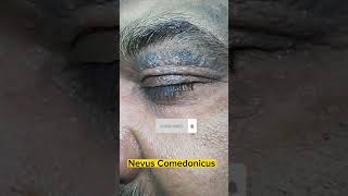 Comedo Nevus😱🔥  Nevus Comedonicus on upper eyelid in old patient dermatology comedone acne scar [upl. by Ahsitahs24]