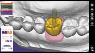 Exocad Digital Workflow with Hollow System [upl. by Nuhsar]