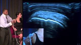 Shoulder Impingement  What Causes It [upl. by Kristin212]