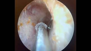 Persistent middle ear fluid may require myringotomy by ENT physician [upl. by Naie957]