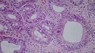 013 Intestinal metaplasia and low grade dysplasia in gastric biopsy [upl. by Sorodoeht]