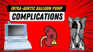 Understanding Intra Aortic Balloon Pump Complications IABP Guide for Nurses [upl. by Atiuqa]