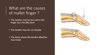 Mallet Finger Explained by Dr Alexander Anzarut [upl. by Deys613]