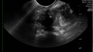 Peritonsillar Abscess Needle Drainage US JETem 2017 [upl. by Leonerd176]