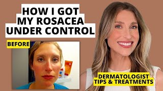 My Rosacea Journey Dermatologist Shares Skincare amp Treatments That Work  Dr Sam Ellis [upl. by Felske]